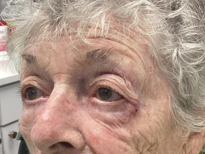 Ectropion Repair 1 After Image