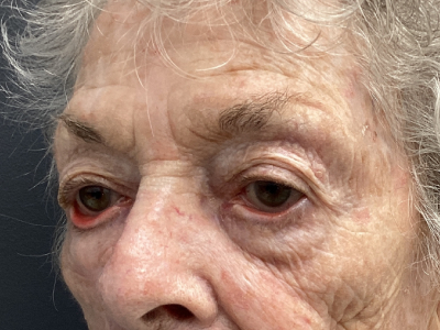 Ectropion Repair 1 Before Image