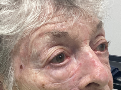 Ectropion Repair 1 After Image