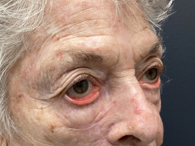 Ectropion Repair 1 Before Image
