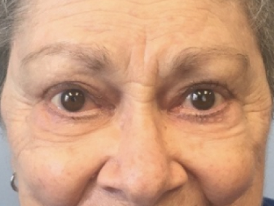 Eyelid Ptosis Repair 1 After Image