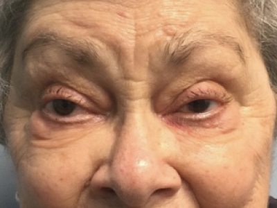 Eyelid Ptosis Repair 1 Before Image