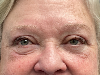 Eyelid Ptosos Repair 2 After Image