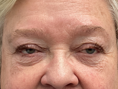 Eyelid Ptosos Repair 2 Before Image