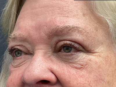 Eyelid Ptosos Repair 2 After Image