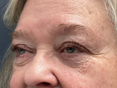 Eyelid Ptosos Repair 2 Before Image