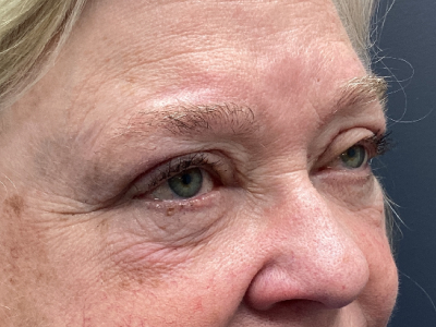 Eyelid Ptosos Repair 2 After Image