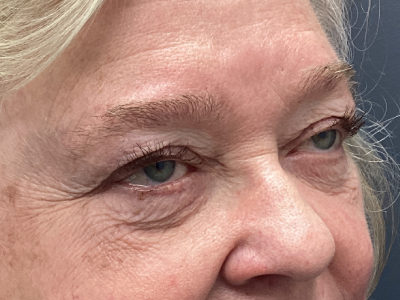 Eyelid Ptosos Repair 2 Before Image