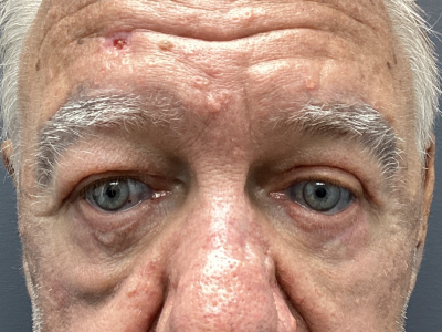 Eyelid Ptosis Repair & Blepharoplasty 3 After Image