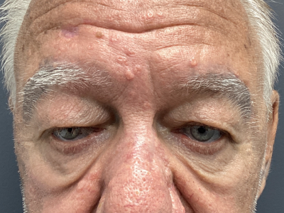 Eyelid Ptosis Repair & Blepharoplasty 3 Before Image