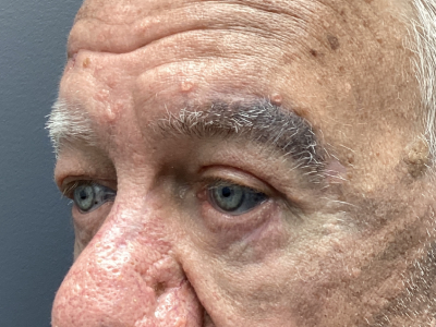 Eyelid Ptosis Repair & Blepharoplasty 3 After Image