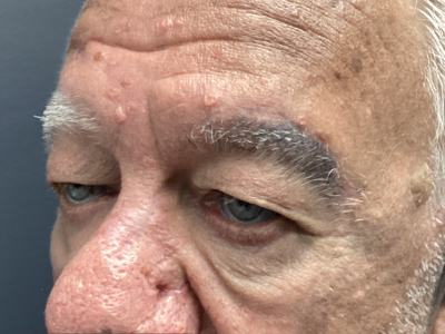 Eyelid Ptosis Repair & Blepharoplasty 3 Before Image