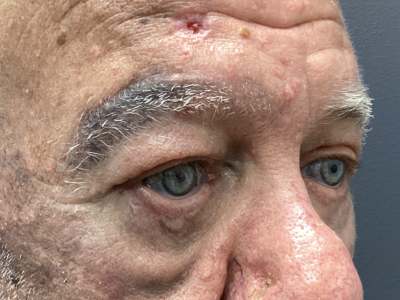 Eyelid Ptosis Repair & Blepharoplasty 3 After Image