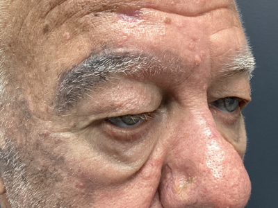 Eyelid Ptosis Repair & Blepharoplasty 3 Before Image