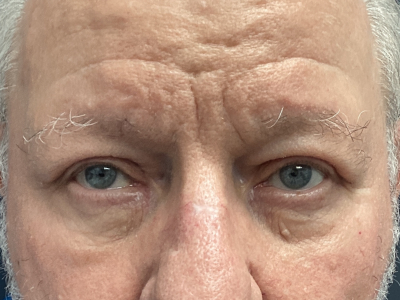 Eyelid Ptosis Repair & Blepharoplasty 4 After Image