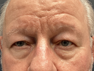 Eyelid Ptosis Repair & Blepharoplasty 4 Before Image