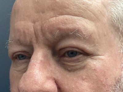 Eyelid Ptosis Repair & Blepharoplasty 4 After Image
