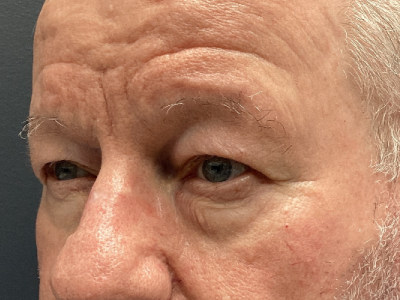 Eyelid Ptosis Repair & Blepharoplasty 4 Before Image