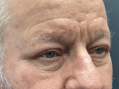 Eyelid Ptosis Repair & Blepharoplasty 4 After Image