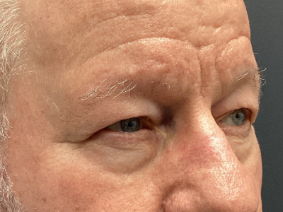 Eyelid Ptosis Repair & Blepharoplasty 4 Before Image