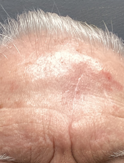 Scar Revision 1 After Image
