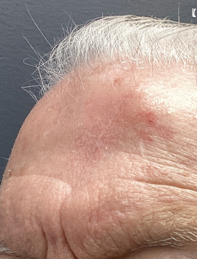 Scar Revision 1 After Image