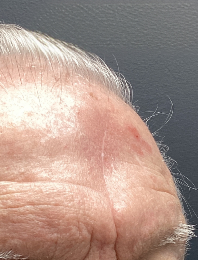 Scar Revision 1 After Image