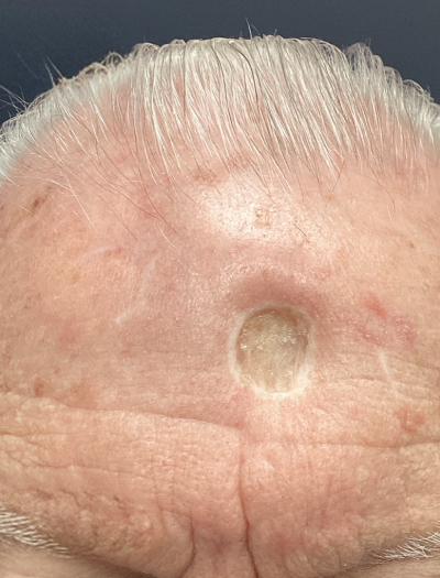 Scar Revision 1 Before Image