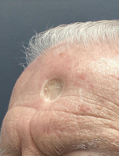 Scar Revision 1 Before Image