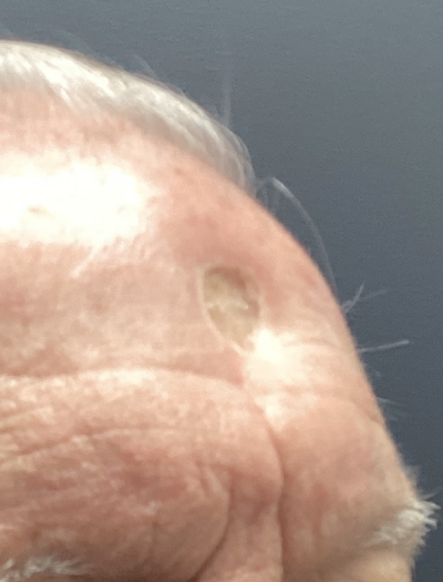 Scar Revision 1 Before Image