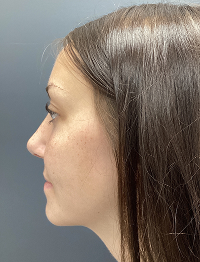 Rhinoplasty 4 After Image