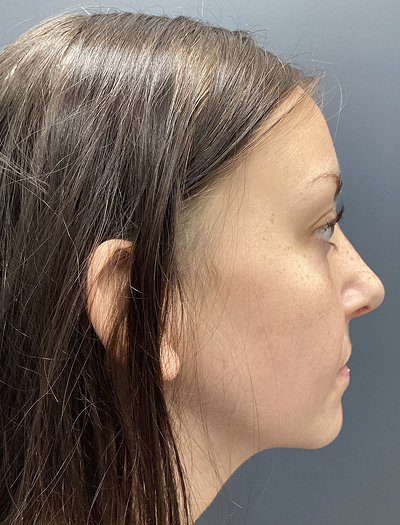 Rhinoplasty 4 After Image