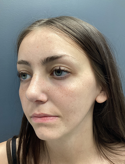 Rhinoplasty 4 After Image
