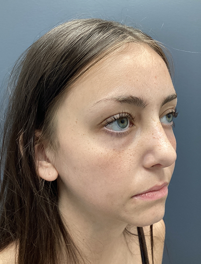 Rhinoplasty 4 After Image