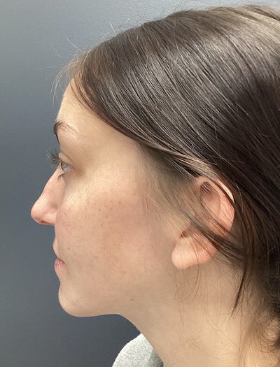 Rhinoplasty 4 Before Image