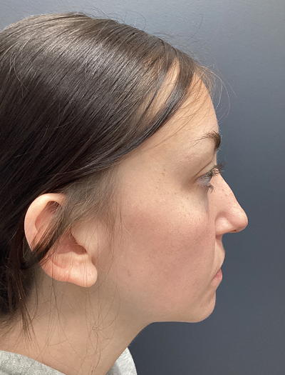 Rhinoplasty 4 Before Image
