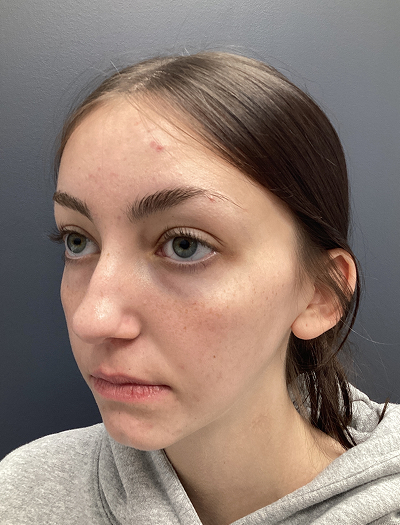 Rhinoplasty 4 Before Image