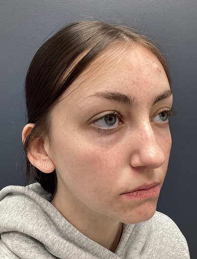 Rhinoplasty 4 Before Image