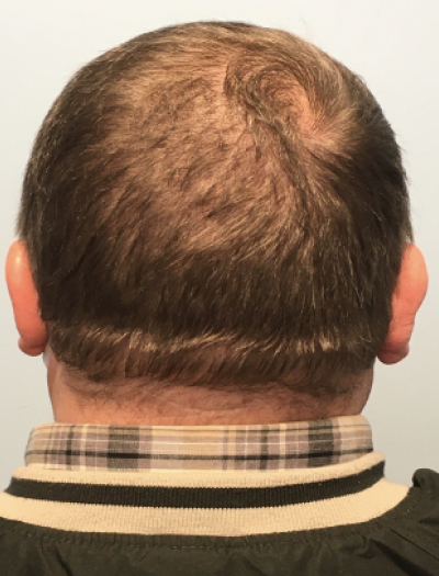 Scalp Reconstruction 1 After Image