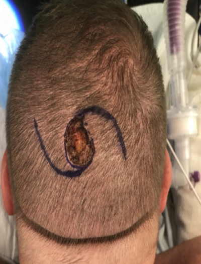 Scalp Reconstruction 1 Before Image